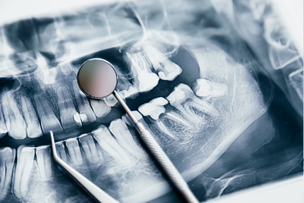 X-ray of teeth and dental cleaning devices